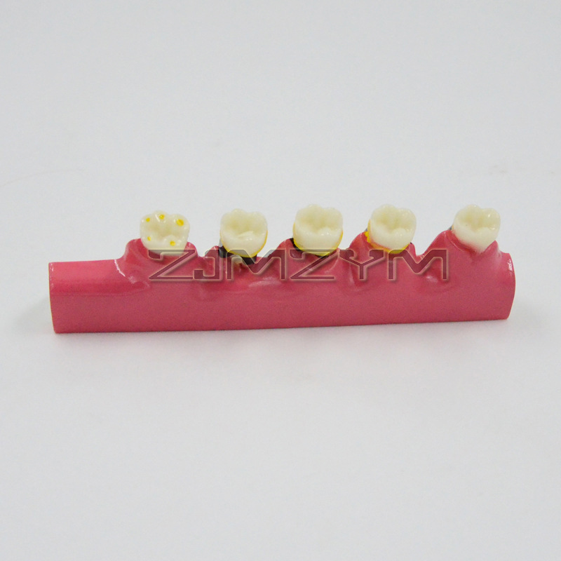 Periodontal Disease Model Dent - Medical Lab Study 评论和价格